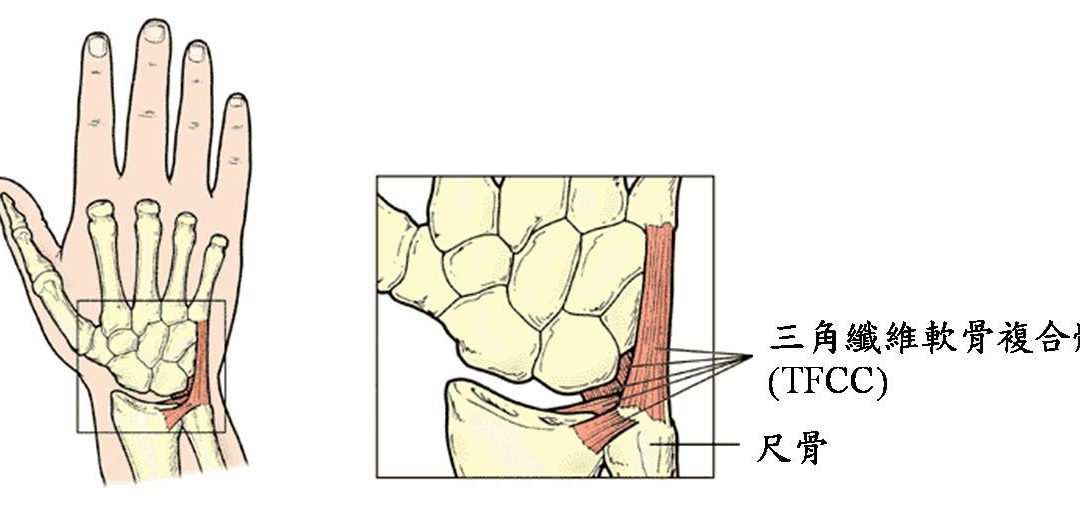 手腕轉動疼痛，久治不癒？當心三角纖維軟骨損傷！