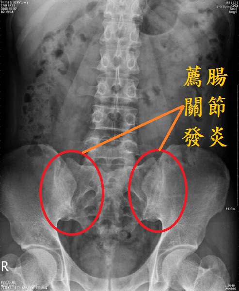 僵直性脊椎炎(Ankylosing Spondylitis，AS)