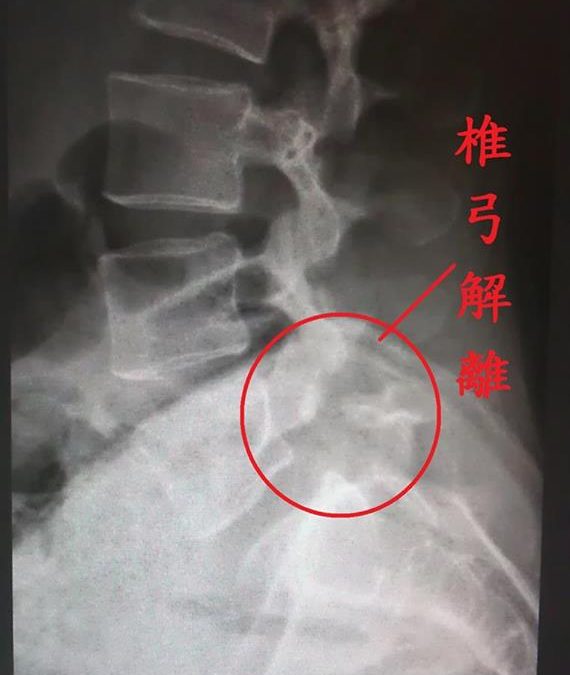 下背痛到難轉身 原來罹椎弓解離