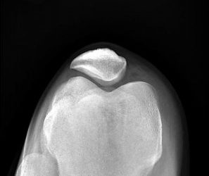 髕骨股骨疼痛症候群 膝蓋彎曲「啪啪」響