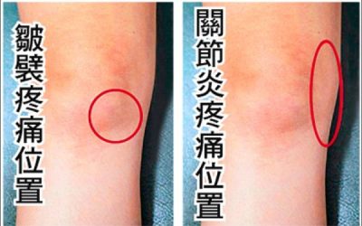 滑膜皺襞症候群作怪 膝痛誤認是退化
