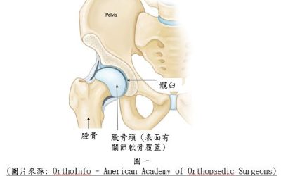 股骨髖臼夾擠症 Femoroacetabular impingement(FAI)