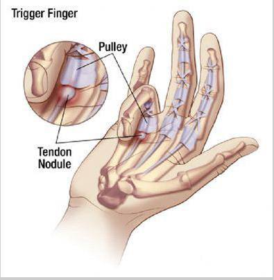 板機指 （trigger finger）