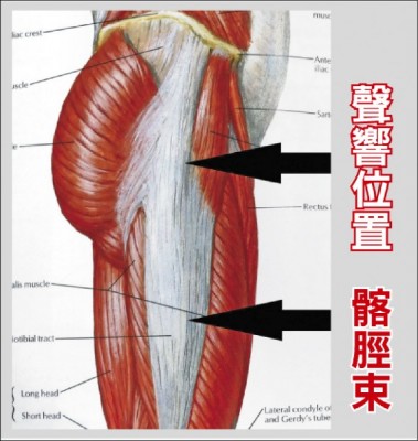 惹上彈響髖症候群 走路「扣扣」響